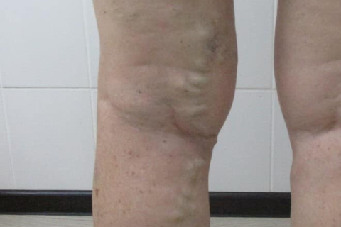 Как развивается хроническая венозная недостаточность