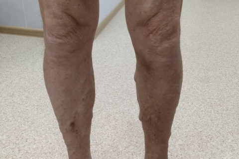 Лечение варикозной болезни с изменениями кожи